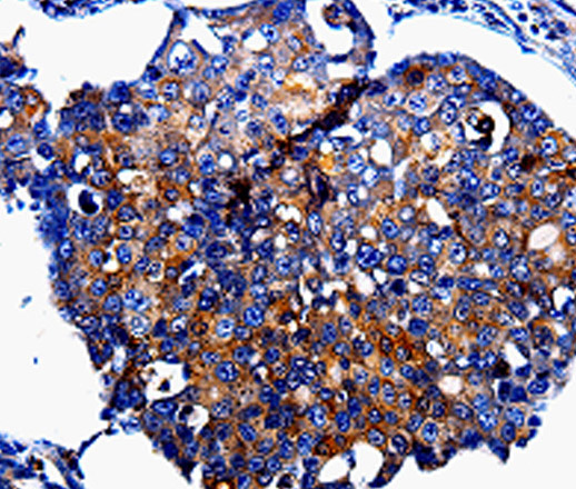 Immunohistochemistry of paraffin-embedded Human breast cancer tissue using IL10RB Polyclonal Antibody at dilution 1:60