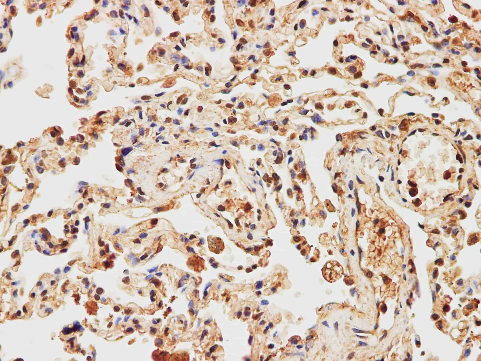 Immunohistochemistry of paraffin-embedded Human lung using IMP3 Polyclonal Antibody at dilution of 1:200