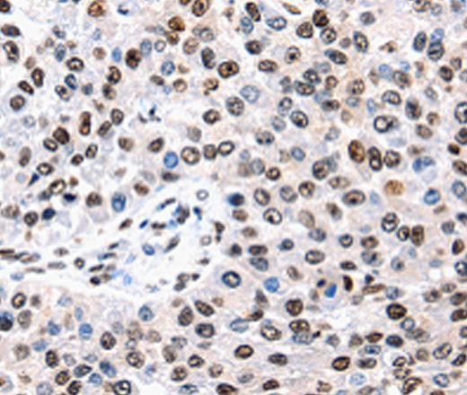 Immunohistochemistry of paraffin-embedded Human renal cancer tissue using AQP2 Polyclonal Antibody at dilution 1:50