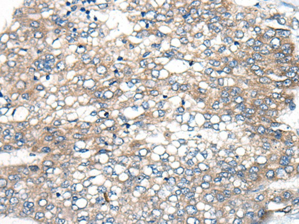 Immunohistochemistry of paraffin-embedded Human liver cancer tissue  using BBS12 Polyclonal Antibody at dilution of 1:50(?200)