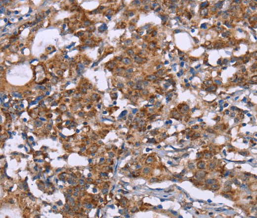 Immunohistochemistry of paraffin-embedded Human gastric cancer tissue using HSP10 Polyclonal Antibody at dilution 1:40