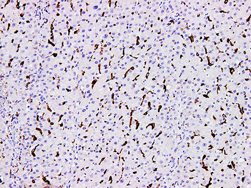 Immunohistochemistry of paraffinembedded Human liver tissue with CD163 Monoclonal Antibody(Antigen repaired by EDTA).