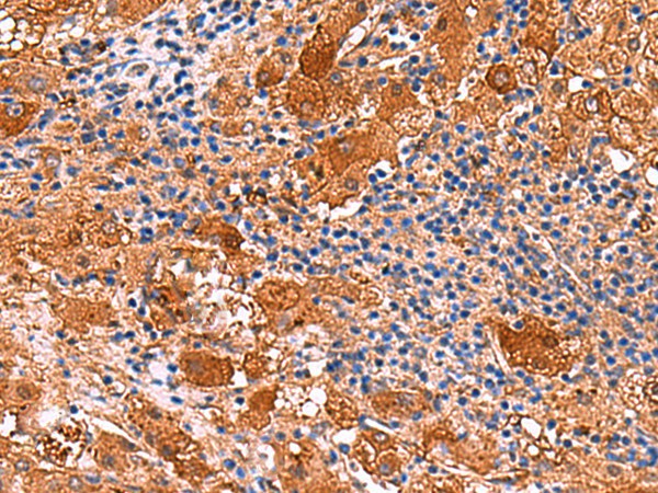 Immunohistochemistry of paraffin-embedded Human liver cancer tissue  using KANK3 Polyclonal Antibody at dilution of 1:50(?200)