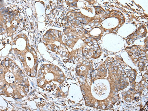 Immunohistochemistry of paraffin-embedded Human colorectal cancer tissue  using APOD Polyclonal Antibody at dilution of 1:55(?200)