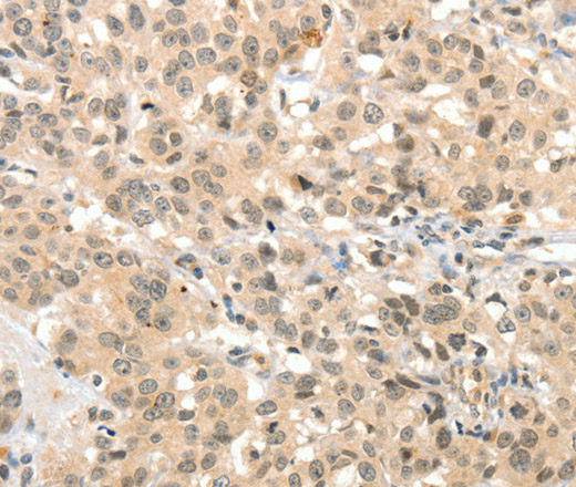 Immunohistochemistry of paraffin-embedded Human esophagus cancer tissue using TSPYL2 Polyclonal Antibody at dilution 1:30