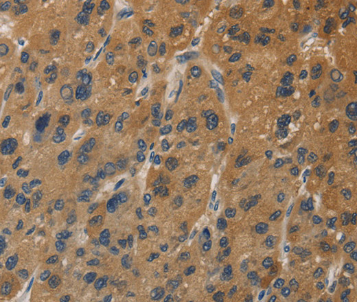 Immunohistochemistry of paraffin-embedded Human liver cancer tissue using DUSP23 Polyclonal Antibody at dilution 1:30