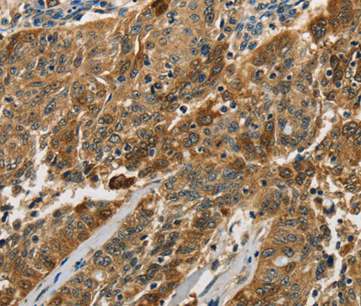 Immunohistochemistry of paraffin-embedded Human ovarian cancer using Cathepsin E Polyclonal Antibody at dilution of 1:50