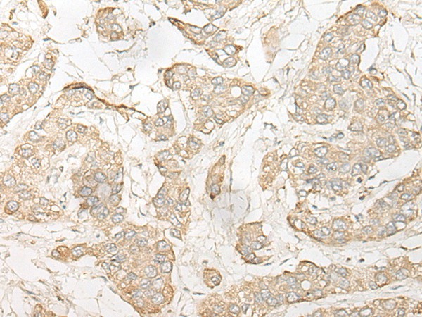 Immunohistochemistry of paraffin-embedded Human liver cancer tissue  using DHRS7 Polyclonal Antibody at dilution of 1:30(?200)