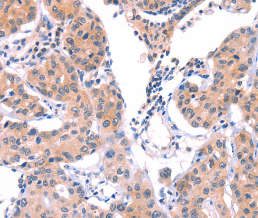 Immunohistochemistry of paraffin-embedded Human lung cancer tissue using VWF Polyclonal Antibody at dilution 1:50