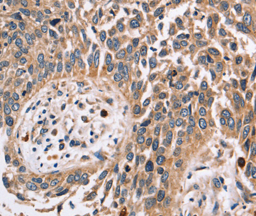 Immunohistochemistry of paraffin-embedded Human lung cancer using FUCA1 Polyclonal Antibody at dilution of 1:30