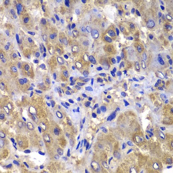 Immunohistochemistry of paraffin-embedded Human liver damage using CARD10 Polyclonal Antibody at dilution of  1:100 (40x lens).