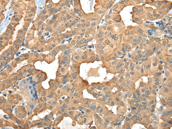 Immunohistochemistry of paraffin-embedded Human thyroid cancer tissue  using C1GALT1C1 Polyclonal Antibody at dilution of 1:45(?200)