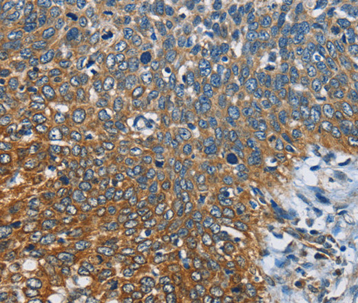 Immunohistochemistry of paraffin-embedded Human cervical cancer tissue using CARD9 Polyclonal Antibody at dilution 1:60