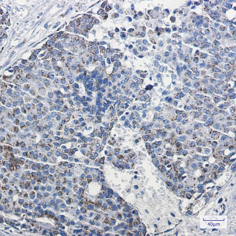 Immunohistochemistry of mtTFA in paraffin-embedded Human breast cancer tissue using mtTFA Rabbit mAb at dilution 1:100