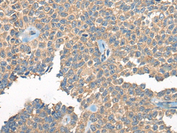 Immunohistochemistry of paraffin-embedded Human ovarian cancer tissue  using PPP3R1 Polyclonal Antibody at dilution of 1:55(?200)