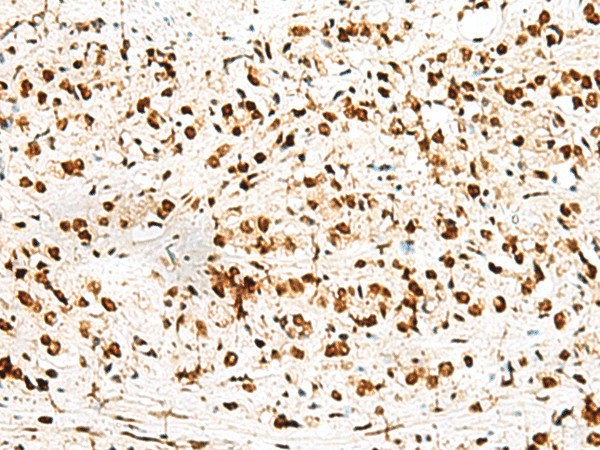 Immunohistochemistry of paraffin-embedded Human prost ate cancer tissue  using RBM12 Polyclonal Antibody at dilution of 1:50(?200)