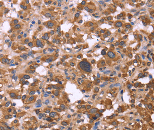 Immunohistochemistry of paraffin-embedded Human thyroid cancer tissue using FBXW7 Polyclonal Antibody at dilution 1:30