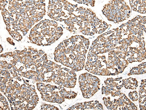 Immunohistochemistry of paraffin-embedded Human esophagus cancer tissue  using CALB1 Polyclonal Antibody at dilution of 1:80(?200)