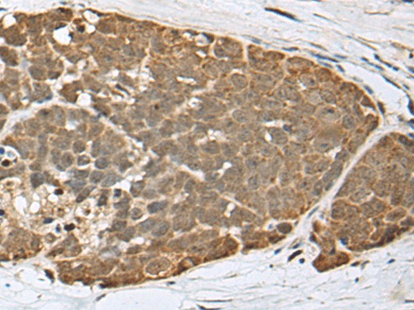 Immunohistochemistry of paraffin-embedded Human thyroid cancer tissue  using SPRTN Polyclonal Antibody at dilution of 1:65(?200)