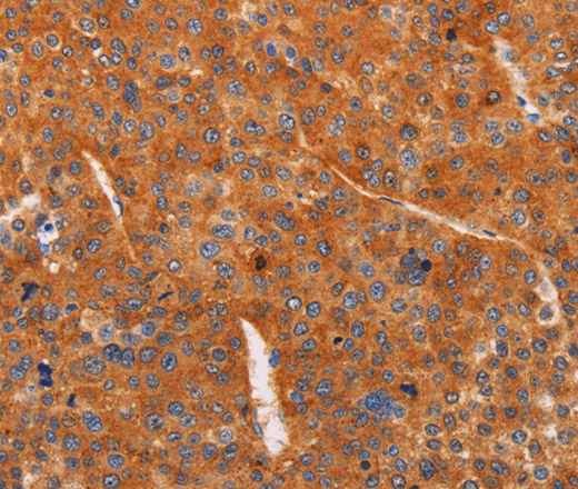 Immunohistochemistry of paraffin-embedded Human liver cancer tissue using ADCY1 Polyclonal Antibody at dilution 1:60