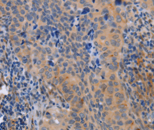 Immunohistochemistry of paraffin-embedded Human cervical cancer tissue using MAP3K13 Polyclonal Antibody at dilution 1:40