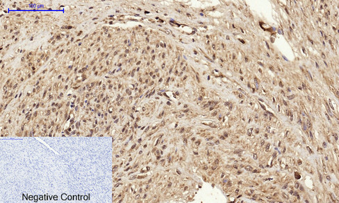 Immunohistochemistry of paraffin-embedded Human uterus cancer tissue using BRCA1 Polyclonal Antibody at dilution of 1:200.