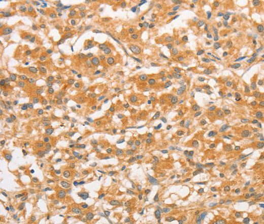 Immunohistochemistry of paraffin-embedded Human thyroid cancer tissue using TLR3 Polyclonal Antibody at dilution 1:50