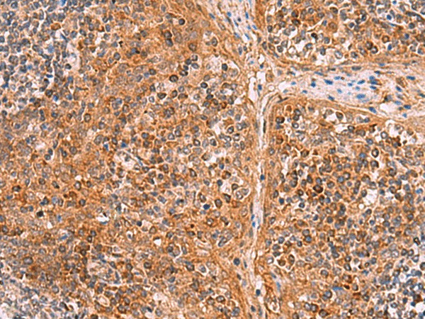 Immunohistochemistry of paraffin-embedded Human tonsil tissue  using CREBBP Polyclonal Antibody at dilution of 1:35(?200)