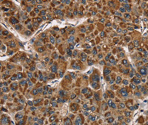 Immunohistochemistry of paraffin-embedded Human liver cancer using CAT Polyclonal Antibody at dilution of 1:40