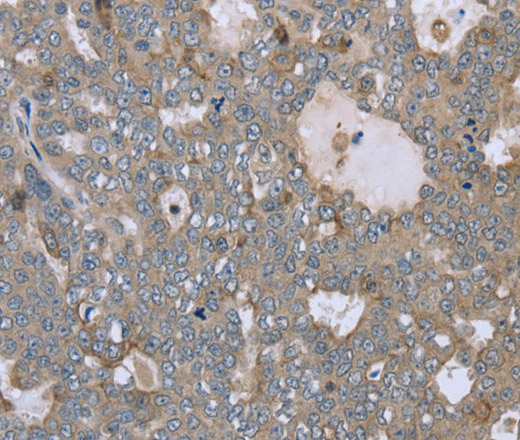 Immunohistochemistry of paraffin-embedded Human ovarian cancer tissue using FAR2 Polyclonal Antibody at dilution 1:40