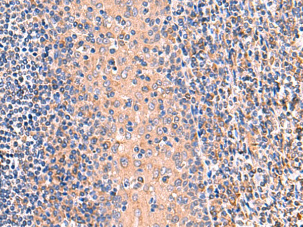 Immunohistochemistry of paraffin-embedded Human tonsil tissue  using OSBPL2 Polyclonal Antibody at dilution of 1:65(?200)