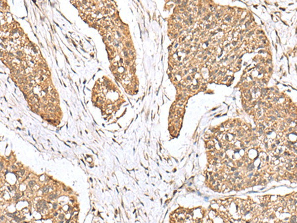 Immunohistochemistry of paraffin-embedded Human esophagus cancer tissue  using PLA2G2A Polyclonal Antibody at dilution of 1:55(?200)