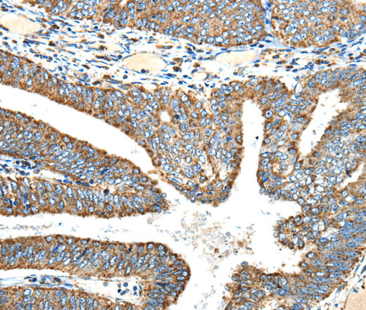 Immunohistochemistry of paraffin-embedded Human colon cancer using NDUFA5 Polyclonal Antibody at dilution of 1:40