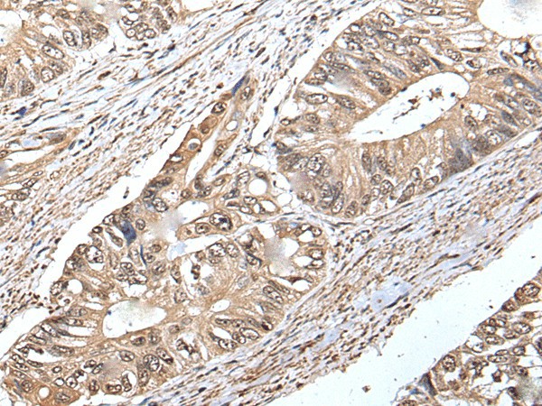 Immunohistochemistry of paraffin-embedded Human colorectal cancer tissue  using ATF6B Polyclonal Antibody at dilution of 1:30(?200)