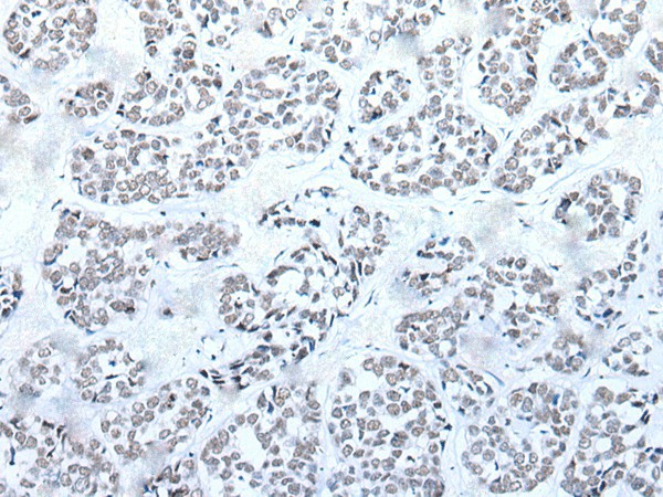 Immunohistochemistry of paraffin-embedded Human esophagus cancer tissue  using BRD3 Polyclonal Antibody at dilution of 1:60(?200)