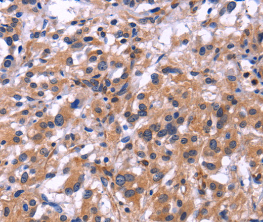 Immunohistochemistry of paraffin-embedded Human thyroid cancer tissue using SIGLEC5 Polyclonal Antibody at dilution 1:30