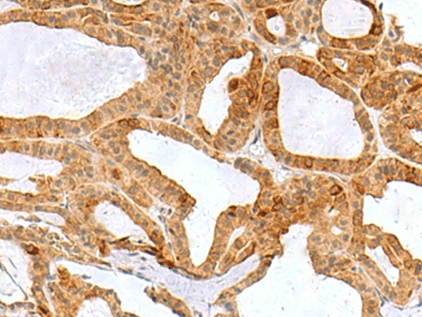 Immunohistochemistry of paraffin-embedded Human thyroid cancer tissue  using RPS16 Polyclonal Antibody at dilution of 1:60(?200)