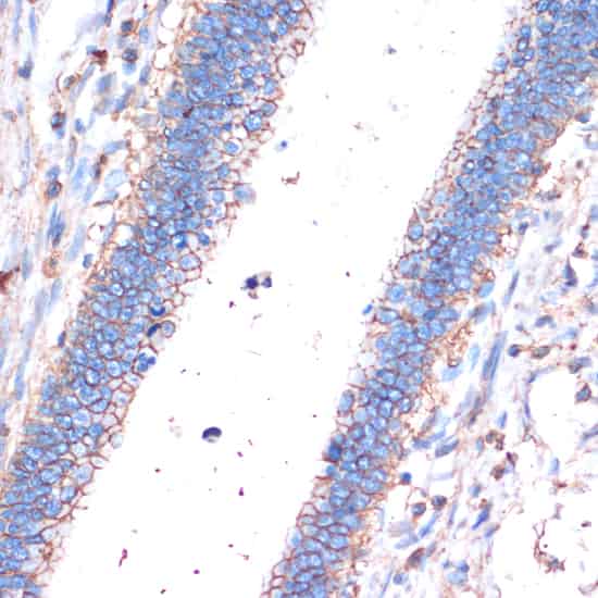 Immunohistochemistry of paraffin-embedded Human colon carcinoma using CD44 Polyclonal Antibody at dilution of 1:200 (40x lens).