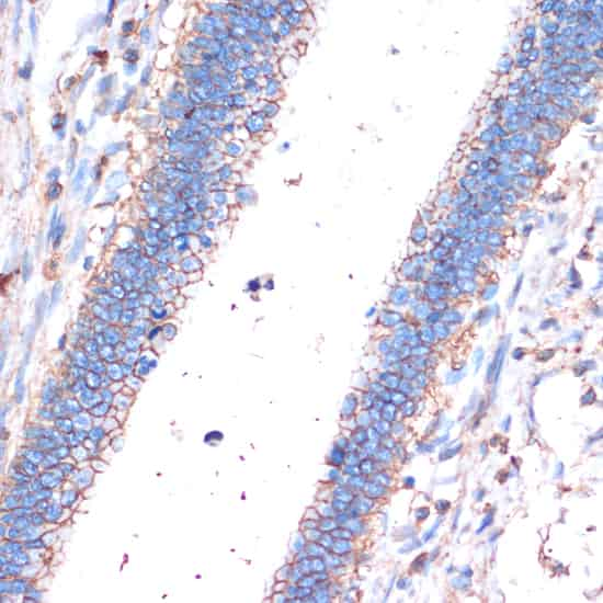 Immunohistochemistry of paraffin-embedded Human colon carcinoma using CD44 Polyclonal Antibody at dilution of  1:200 (40x lens).