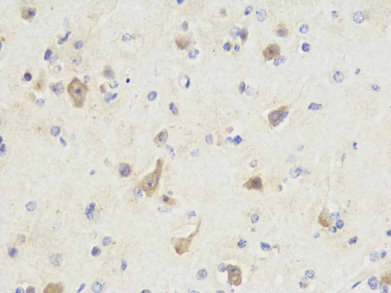 Immunohistochemistry analysis of paraffin-embedded Human brain cancer  using NOS1 Polyclonal Antibody at dilution of 1:300.