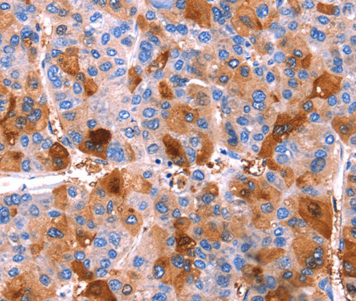 Immunohistochemistry of paraffin-embedded Human liver cancer tissue using ERN2 Polyclonal Antibody at dilution 1:40