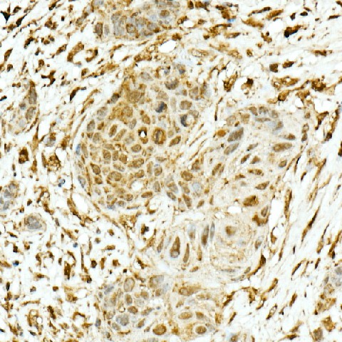 Immunohistochemistry of paraffin-embedded human esophageal cancer using NRF2 Polyclonal Antibody at dilution of 1:200 (40x lens).Perform high pressure antigen retrieval with 10 mM citrate buffer pH 6.0 before commencing with IHC staining protocol.