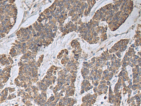 Immunohistochemistry of paraffin-embedded Human colorectal cancer tissue  using CCNF Polyclonal Antibody at dilution of 1:30(?200)