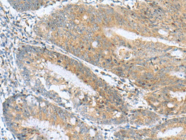 Immunohistochemistry of paraffin-embedded Human colorectal cancer tissue  using NANP Polyclonal Antibody at dilution of 1:50(?200)