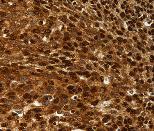 Immunohistochemistry of paraffin-embedded Human cervical cancer tissue using SCN1A Polyclonal Antibody at dilution 1:50