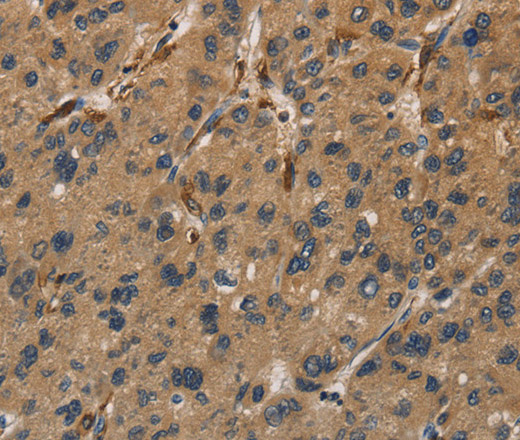 Immunohistochemistry of paraffin-embedded Human liver cancer tissue using UBE2S Polyclonal Antibody at dilution 1:40