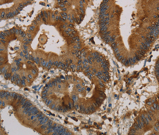 Immunohistochemistry of paraffin-embedded Human colon cancer using CK-16 Polyclonal Antibody at dilution of 1:30