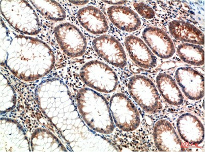 Immunohistochemistry of paraffin-embedded Human colon carcinoma tissue using ATM Monoclonal Antibody at dilution of 1:200.