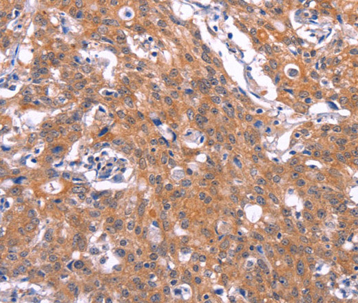 Immunohistochemistry of paraffin-embedded Human gastic cancer using CD269 Polyclonal Antibody at dilution of 1:30