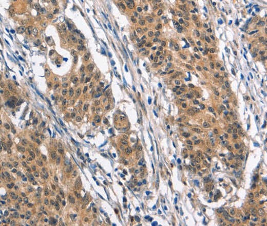 Immunohistochemistry of paraffin-embedded Human gastric cancer tissue using BNIP3L Polyclonal Antibody at dilution 1:40